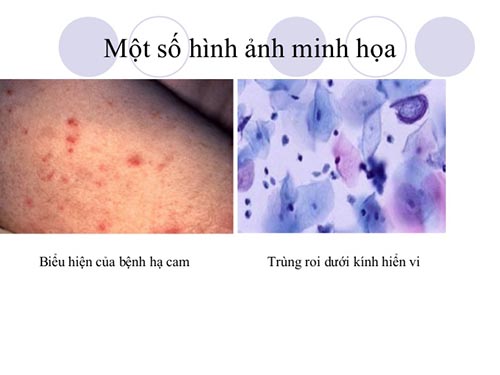 Trực khuẩn gram âm Haemophilus ducreyi là căn nguyên gây bệnh hạ cam